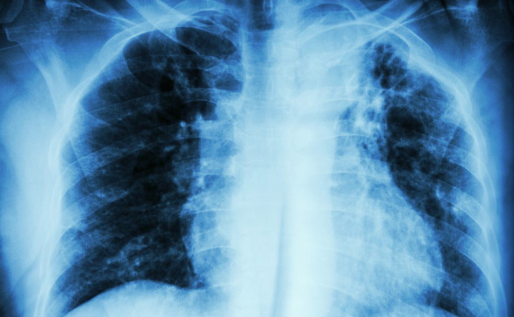 COVID-19 e Fibrose Pulmonar