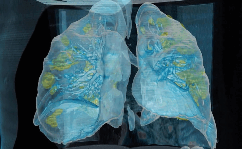 Hipóxia silenciosa ou Hipóxia feliz